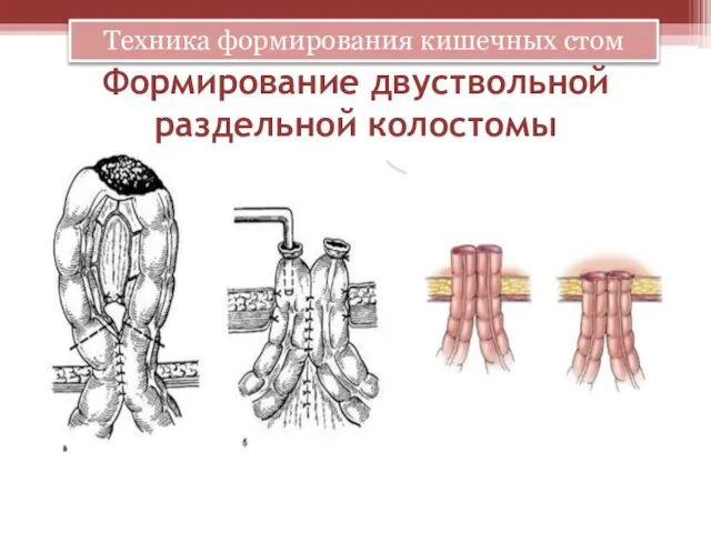 Формирование двуствольной раздельной колостомы Техника формирования кишечных стом