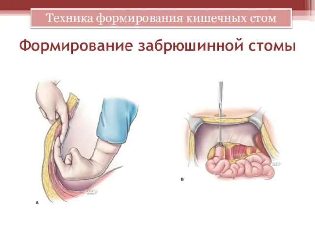 Формирование забрюшинной стомы Техника формирования кишечных стом