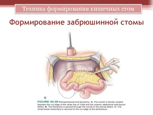 Формирование забрюшинной стомы Техника формирования кишечных стом