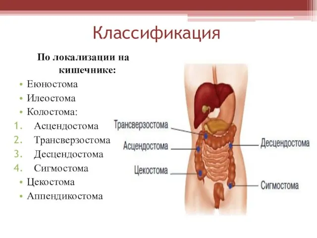 Классификация По локализации на кишечнике: Еюностома Илеостома Колостома: Асцендостома Трансверзостома Десцендостома Сигмостома Цекостома Аппендикостома