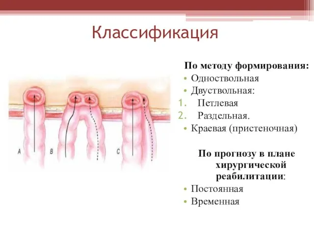 Классификация По методу формирования: Одноствольная Двуствольная: Петлевая Раздельная. Краевая (пристеночная) По прогнозу