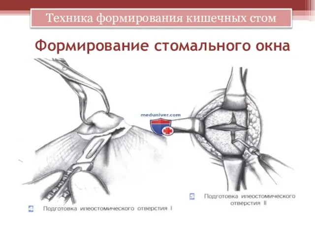 Формирование стомального окна Техника формирования кишечных стом