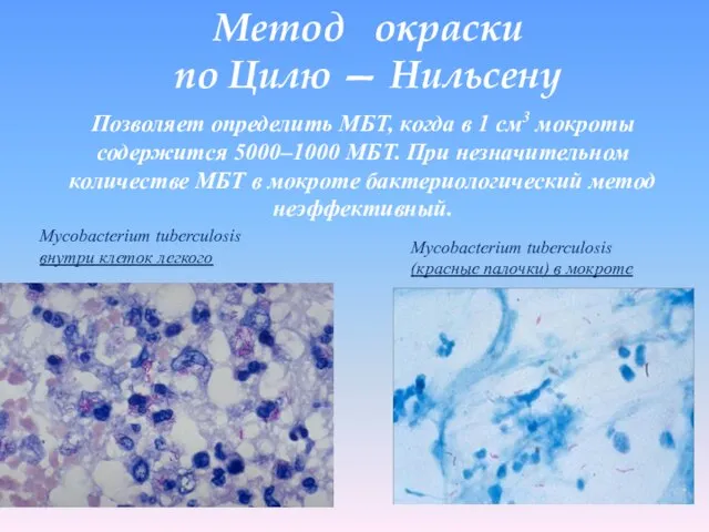 Метод окраски по Цилю — Нильсену Mycobacterium tuberculosis внутри клеток легкого Mycobacterium