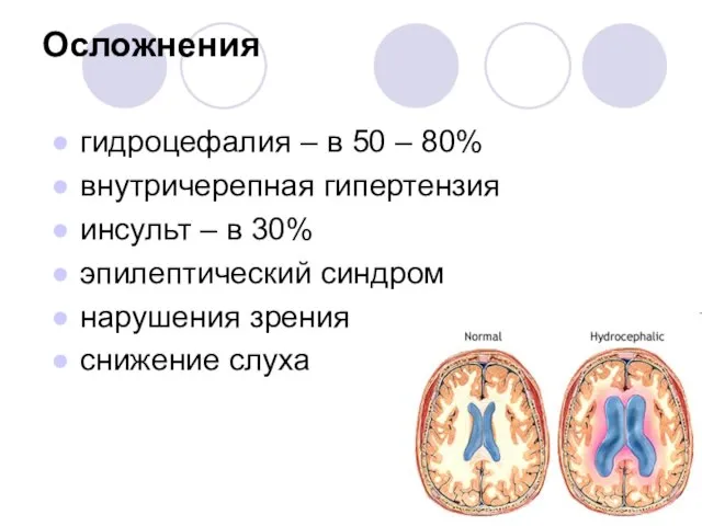 Осложнения гидроцефалия – в 50 – 80% внутричерепная гипертензия инсульт – в