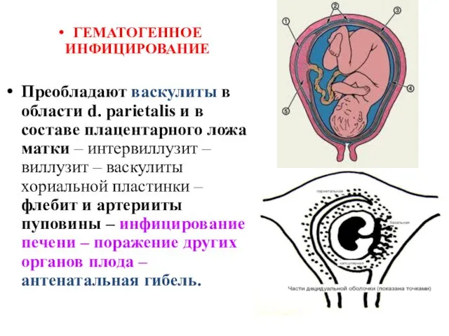 ГЕМАТОГЕННОЕ ИНФИЦИРОВАНИЕ Преобладают васкулиты в области d. parietalis и в составе плацентарного