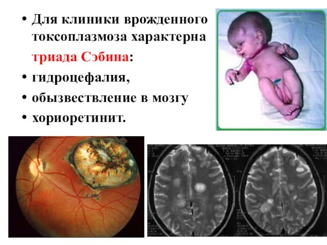 Для клиники врожденного токсоплазмоза характерна триада Сэбина: гидроцефалия, обызвествление в мозгу хориоретинит.