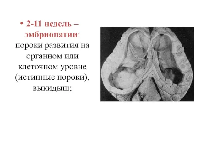 2-11 недель – эмбриопатии: пороки развития на органном или клеточном уровне (истинные пороки), выкидыш;