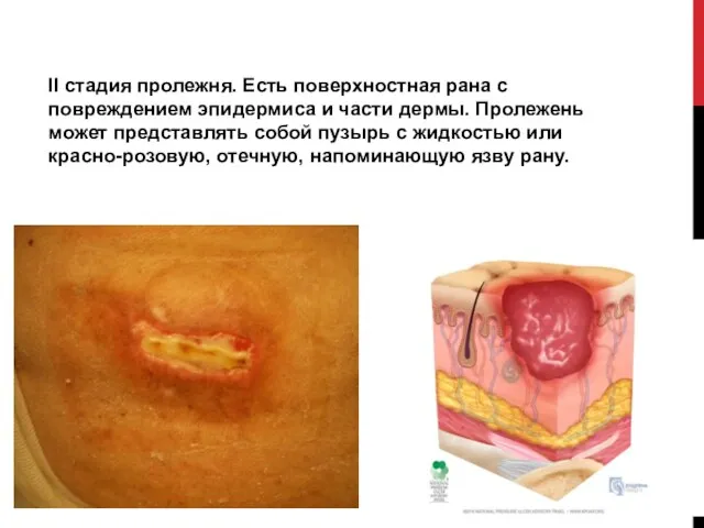 II стадия пролежня. Есть поверхностная рана с повреждением эпидермиса и части дермы.