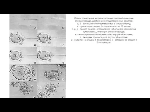 Этапы проведения интрацитоплазматической инъекции сперматозоида, дробление оплодотворённых ооцитов: а, б - засасывание