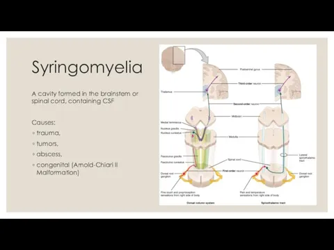 Syringomyelia A cavity formed in the brainstem or spinal cord, containing CSF