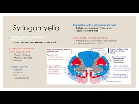 Syringomyelia Anterior white commissure of spinothalamic tract pain, pressure, temperature, crude touch