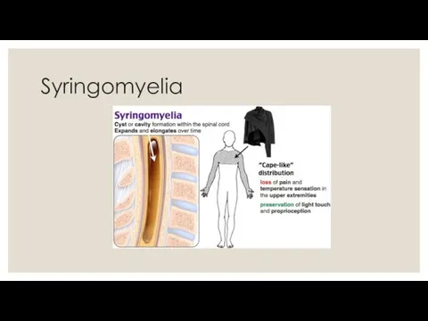 Syringomyelia