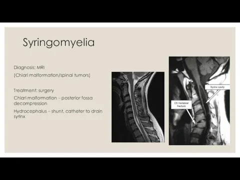 Syringomyelia Diagnosis: MRI (Chiari malformation/spinal tumors) Treatment: surgery Chiari malformation – posterior