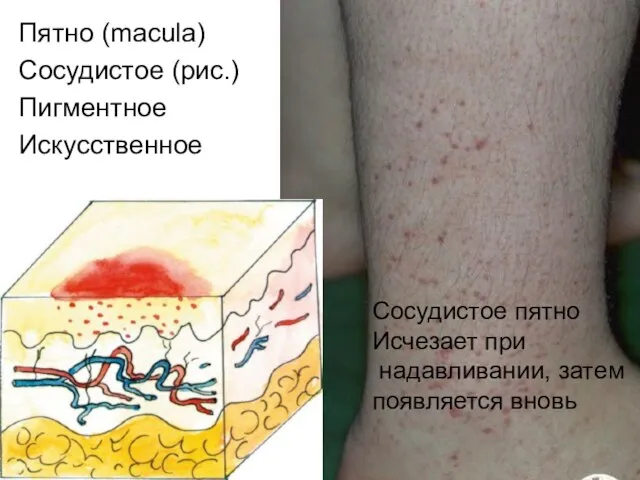 Пятно (macula) Сосудистое (рис.) Пигментное Искусственное Сосудистое пятно Исчезает при надавливании, затем появляется вновь