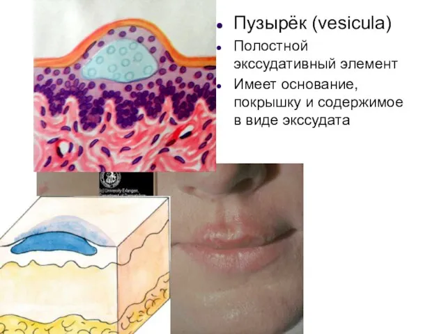 Пузырёк (vesicula) Полостной экссудативный элемент Имеет основание, покрышку и содержимое в виде экссудата