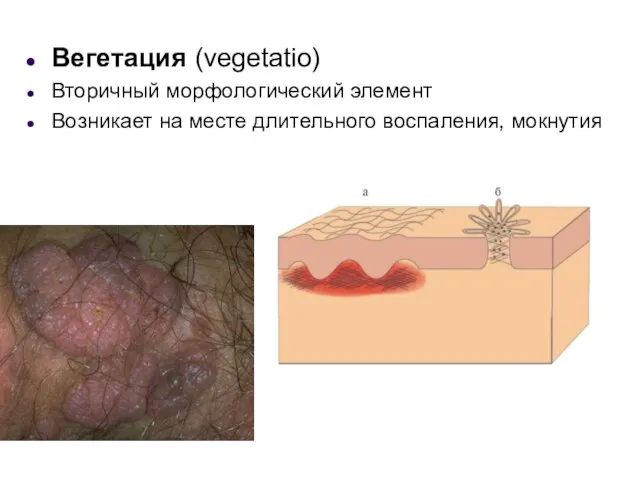 Вегетация (vegetatio) Вторичный морфологический элемент Возникает на месте длительного воспаления, мокнутия