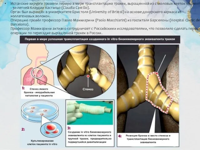 Испанские хирурги провели первую в мире трансплантацию трахеи, выращенной из стволовых клеток