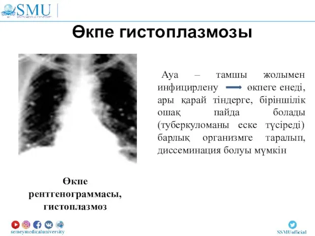 Өкпе гистоплазмозы Өкпе рентгенограммасы, гистоплазмоз Ауа – тамшы жолымен инфицирлену өкпеге енеді,