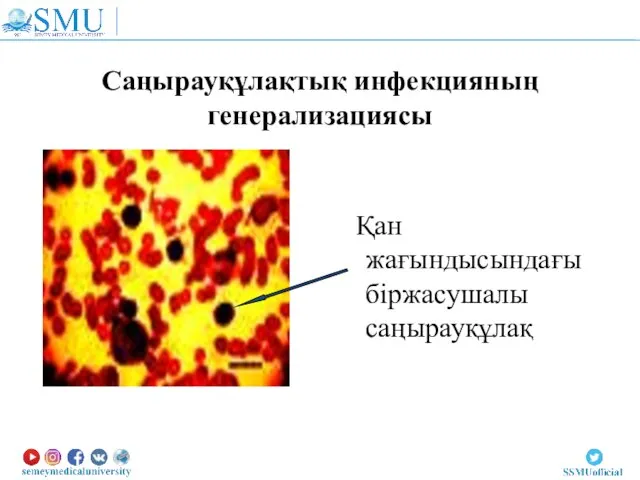 Саңырауқұлақтық инфекцияның генерализациясы Қан жағындысындағы біржасушалы саңырауқұлақ