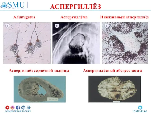 АСПЕРГИЛЛЁЗ A.fumigatus Аспергиллёма Инвазивный аспергиллёз Аспергиллёз сердечной мышцы Аспергиллёзный абсцесс мозга