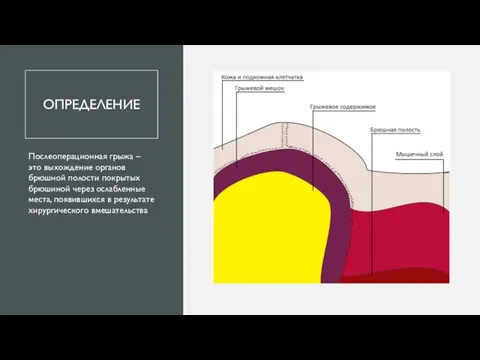 ОПРЕДЕЛЕНИЕ Послеоперационная грыжа – это выхождение органов брюшной полости покрытых брюшиной через