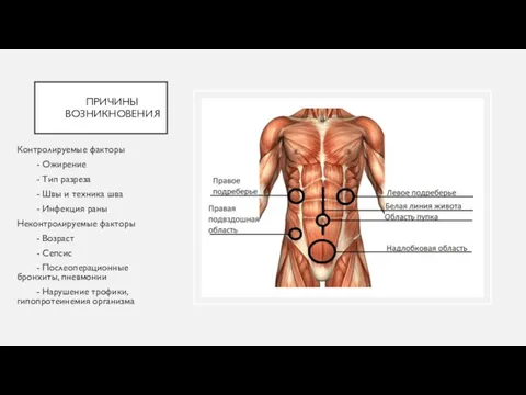 ПРИЧИНЫ ВОЗНИКНОВЕНИЯ Контролируемые факторы - Ожирение - Тип разреза - Швы и