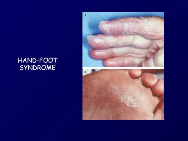 HAND-FOOT SYNDROME