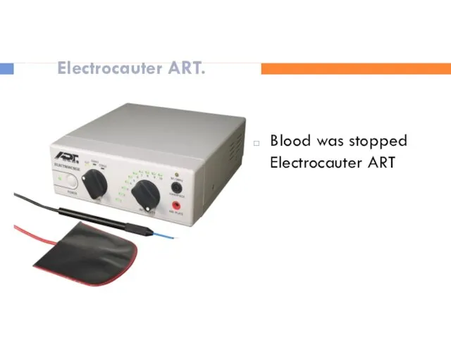 Electrocauter ART. Blood was stopped Electrocauter ART