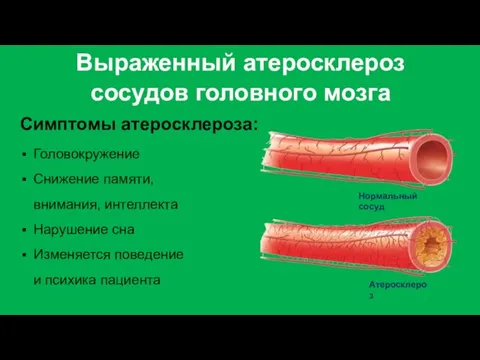 Выраженный атеросклероз сосудов головного мозга Симптомы атеросклероза: Головокружение Снижение памяти, внимания, интеллекта