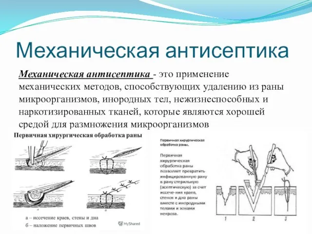 Механическая антисептика Механическая антисептика - это применение механических методов, способствующих удалению из