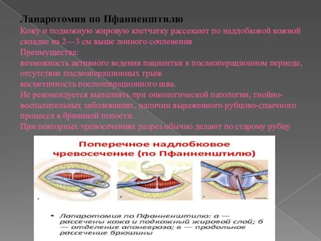 Лапаротомия по Пфанненштилю Кожу и подкожную жировую клетчатку рассекают по надлобковой кожной