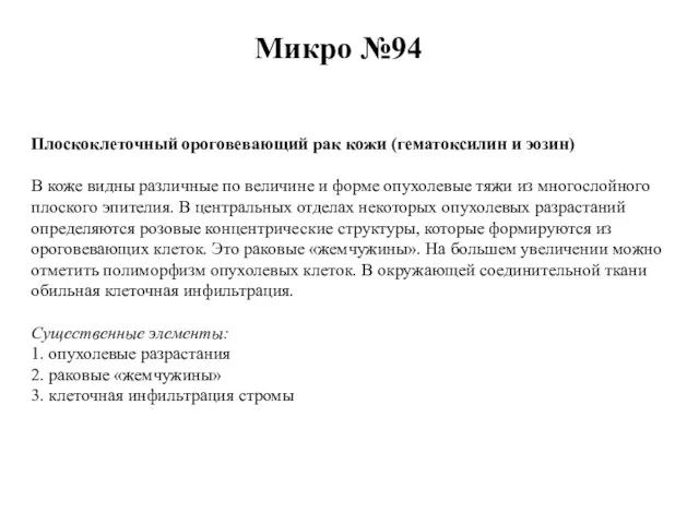 Микро №94 Плоскоклеточный ороговевающий рак кожи (гематоксилин и эозин) В коже видны