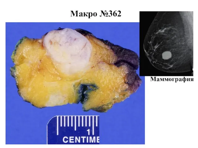 Макро №362 Маммография