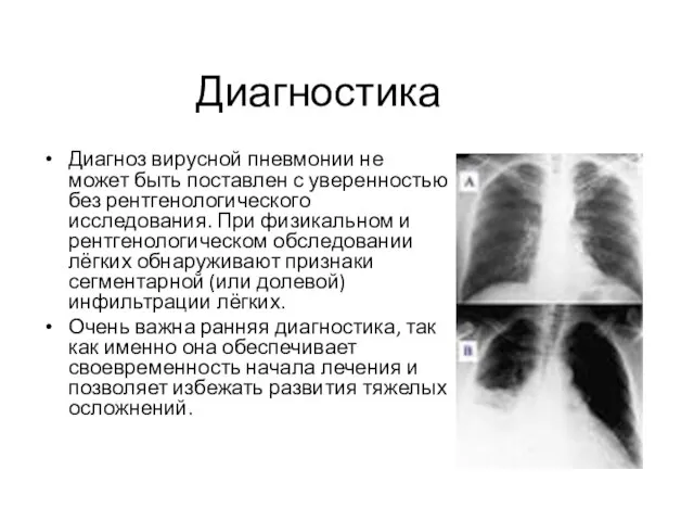 Диагностика Диагноз вирусной пневмонии не может быть поставлен с уверенностью без рентгенологического