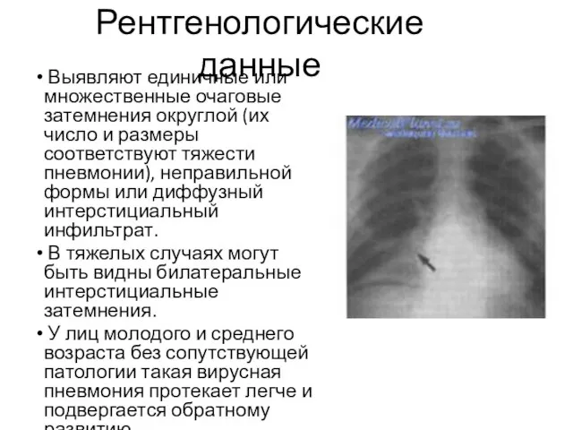 Рентгенологические данные Выявляют единичные или множественные очаговые затемнения округлой (их число и