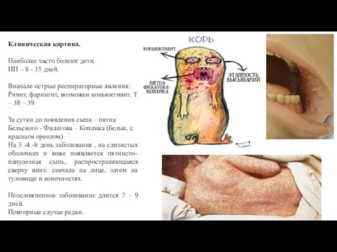 Клиническая картина. Наиболее часто болеют дети. ИП – 8 - 15 дней.