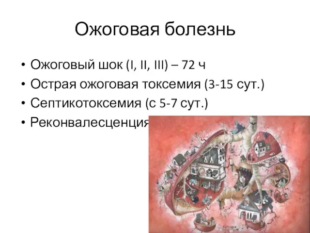 Ожоговая болезнь Ожоговый шок (I, II, III) – 72 ч Острая ожоговая