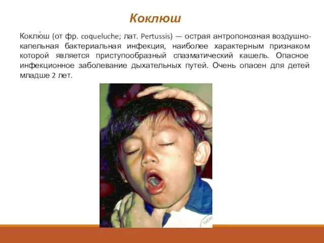 Коклюш Коклю́ш (от фр. coqueluche; лат. Pertussis) — острая антропонозная воздушно-капельная бактериальная