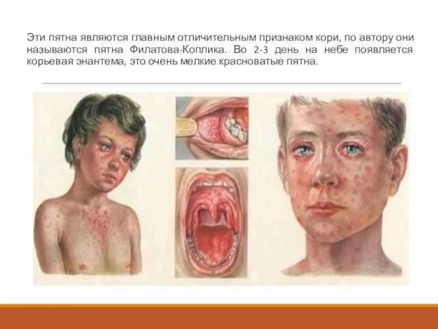 Эти пятна являются главным отличительным признаком кори, по автору они называются пятна