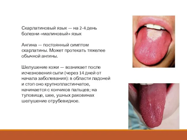 Скарлатиновый язык — на 2-4 день болезни-»малиновый» язык Ангина — постоянный симптом