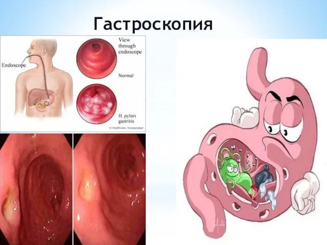 Гастроскопия