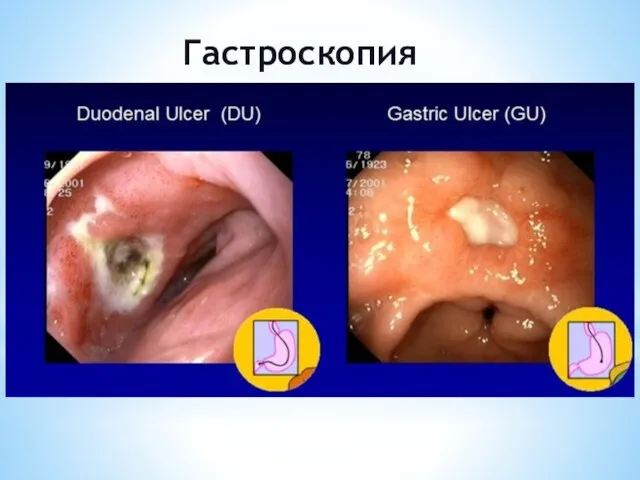 Гастроскопия