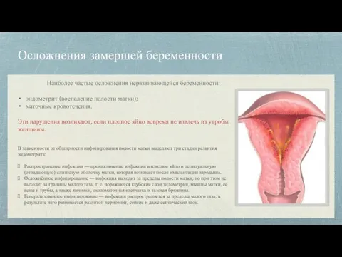 Осложнения замершей беременности Наиболее частые осложнения неразвивающейся беременности: эндометрит (воспаление полости матки);