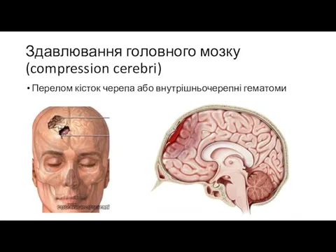 Здавлювання головного мозку (compression cerebri) Перелом кісток черепа або внутрішньочерепні гематоми