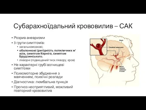 Субарахноїдальний крововилив – САК Розрив аневризми 3 групи симптомів: загальномозкові; оболонкові (ригідність