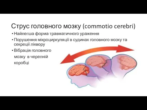 Струс головного мозку (commotio cerebri) Найлегша форма травматичного ураження Порушення мікроциркуляції в