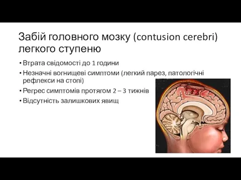 Забій головного мозку (contusion cerebri) легкого ступеню Втрата свідомості до 1 години