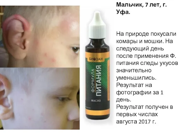 Мальчик, 7 лет, г. Уфа. На природе покусали комары и мошки. На