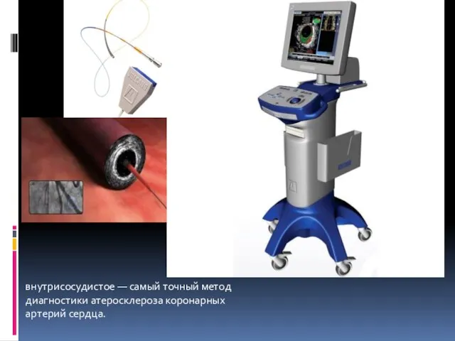 внутрисосудистое — самый точный метод диагностики атеросклероза коронарных артерий сердца.