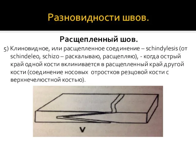 Разновидности швов. Расщепленный шов. 5) Клиновидное, или расщепленное соединение – schindylesis (от